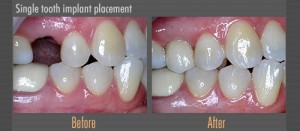 Singe tooth Implant placement