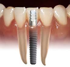 Boca Raton Dental Implants